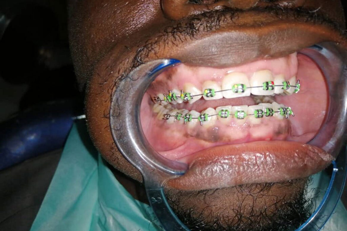 Orthodontics or braces in Uganda