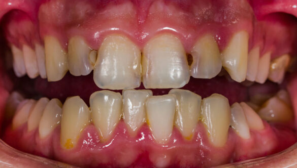 Possible Causes of tooth decays